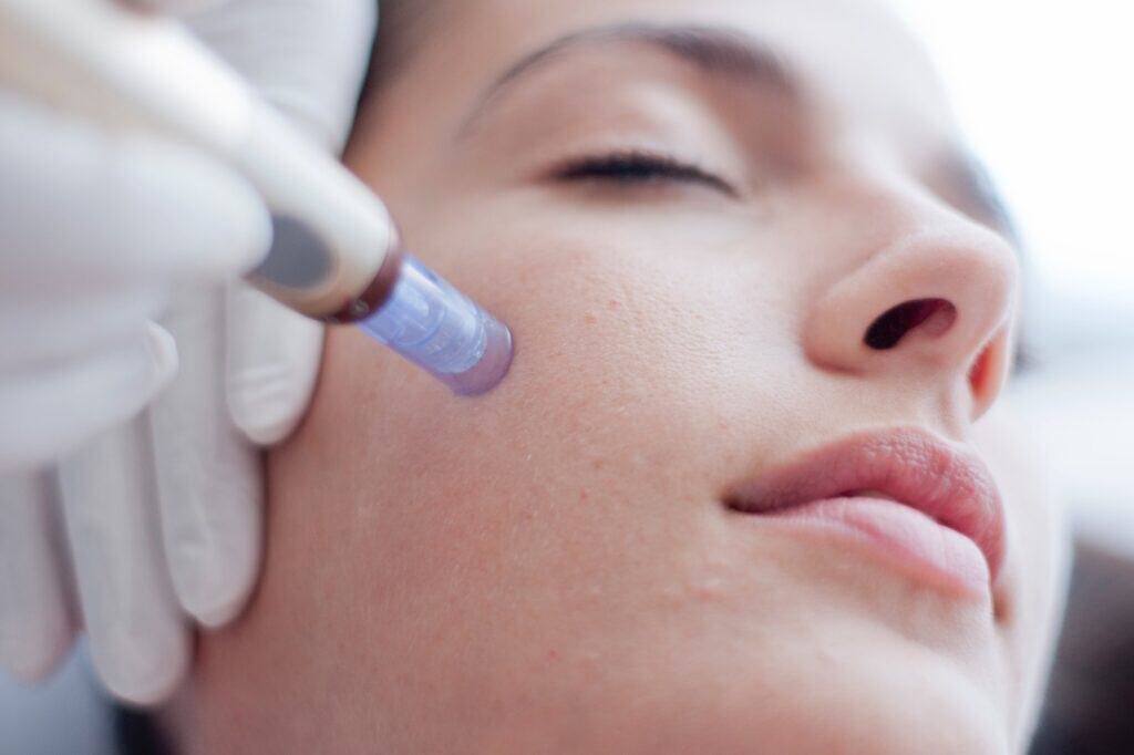 microneedling